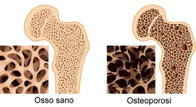 Osteoporosi