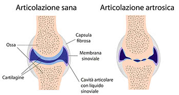 Articolazioni sane e artrosiche