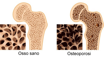 Osteoporosi