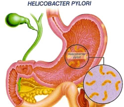 Helicobacter pylori