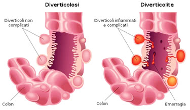 Diverticoli colon