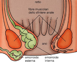 Emorroidi