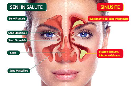 Seni paranasali sani e infiammati