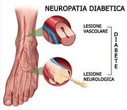 Neuropatia diabetica