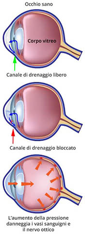 Glaucoma