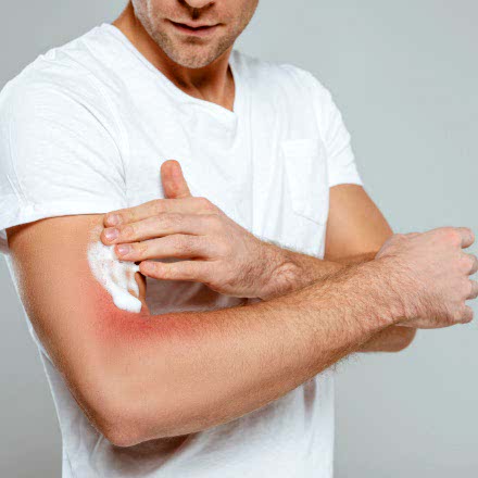Prodotti per dermatite, eritemi, eczemi